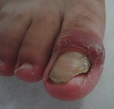 Image result for Paronychia feet