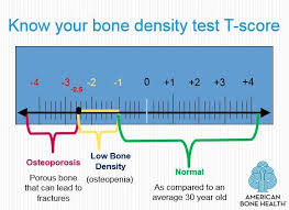 Understanding Bone Density Results American Bone Hea