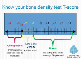 understanding bone density results american bone hea