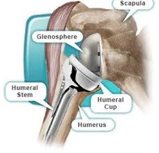 Reverse Shoulder Replacement Shoulderpainsolutions Com Reverse Shoulder Replacement Shoulder Surgery Recovery Shoulder Surgery