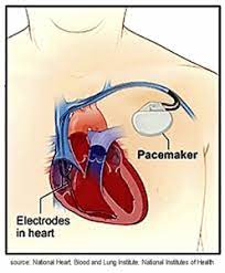 By sorin lazar, henry huang and erik wissner. Pacemakers Icds