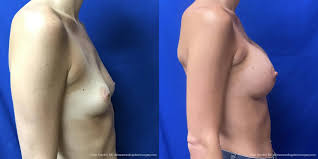 Breast Augmentation Before & After Gallery: Patient 186