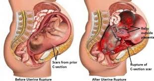 Pin By Stem Cell Transplantation On Stem Cell Cerebral Palsy Cerebral Palsy Cerebral Palsy Causes Spinal Cord Injury