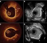 OCT-guided PCI improves survival after life-threatening ...