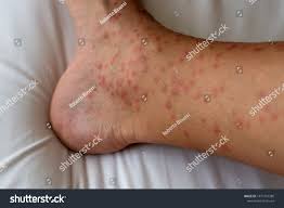 Image result for Papular urticaria