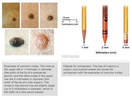National Cancer Institute Can A Common Mole Turn Into Melanoma The Most Serious Form Of Skin Cancer Yes But A Common Mole Rarely Turns Into A Melanoma As Our Fact Sheet