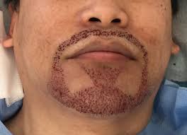 According to the the international society of hair restoration surgery, (ishrs) announced in june 2020 that beard and moustache remain popular areas for hair. Beard Transplant Westminister Clinic