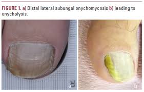 Image result for onychomycosis