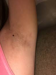 Laser removal can be done in variety of areas of your body such as the face, legs, arms, underarms, bikini line, and a. Laser Hair Removal Dark Spots Underarms Photos