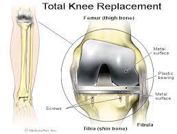 Total Knee Replacement Surgery Total Knee Arthroplasty In Singapore Singapore Sports And Orthopaedic Clinic