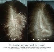So, if you notice that your hair is thinning and you are over 40, know that you are not alone; Thinning Hair