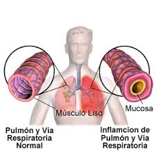 Resultado de imagen para imagenes de la neumonia