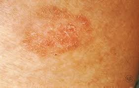 Detecting lip cancer early have good prognosis. Pin On Health