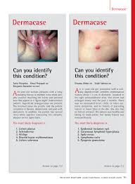 Lichcyr lichdash lichdyth liche liched lichen lichfen… Pdf Question Can You Identify This Condition Lichen Sclerosus