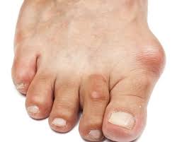 Bunions Calluses And Other Annoying Reasons Your Feet Hurt So Much Home Remedies For Gout Gout Remedies Gout