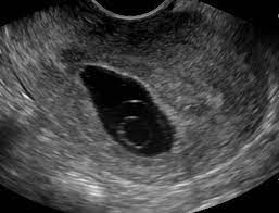 See full list on radiopaedia.org What Might Have Been My Blighted Ovum Story Pregnancyloss This West Coast Mommy