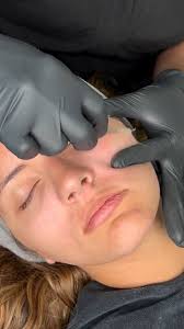 Say goodbye to fuzz and hello to silky smooth skin! Book your next  dermaplaning facial today online at CocMED.com💻 or call us at  (303)797-1150📞, #facial #satisfying #dermaplaning #coloradomedspa