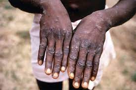 Monkeypox typically presents clinically with fever, rash and swollen lymph nodes. Urrc0xf7dthtjm