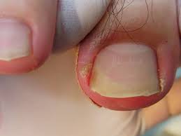 剥がれ かけ の 爪