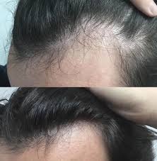 Prp therapy is becoming a popular complement to hair transplants. Prp For Hair Loss Dr Medispa Award Winning Clinics