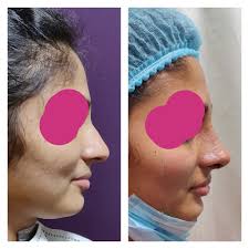 They are correction of congenital deformities and those arising from. Nose Surgery Cost Bangalore Leading Nose Reshaping Rhinoplasty Surgeon In India
