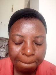 Having rashes all over my face , what can I use. Dark skin.