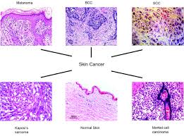 Normal moles don&#x27;t typically turn into melanoma with 70% of. The Characteristic Histology Of Melanoma Bcc Scc And Some Rare Skin Download Scientific Diagram