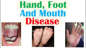 Image result for Hand foot and mouth disease HFMD roof of mouth