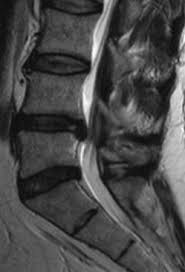 Ein bandscheibenvorfall ist eine degenerative und verschleißbedingte erkrankung an den bandscheiben und lendenwirbelsäule oder halswirbelsäule. Lumbaler Bandscheibenvorfall Neurochirurgie Wirbelsaulenchirurgie Koln Siegburg
