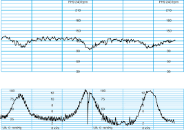 Image result for Early Deceleration