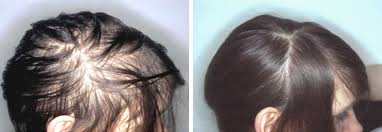 Iron deficiency hair loss is caused when the body lacks enough iron to produce hemoglobin in the blood. Events Hair Nail