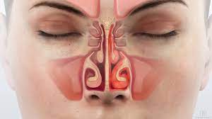 Allergic Rhinitis Dallas Ent