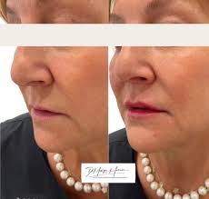 Forest Hill medispa @Forest Hill Plastic Surgery