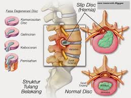 Jika anda berminat untuk jana pendapatan lumayan bersama shaklee.saya akan tunjukkan jalan. Lihat Pesakit Slip Disc Ini Kembali Sembuh Tanpa Pembedahan I Am Zuraida