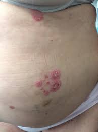 Image result for koebner phenomenon psoriasis