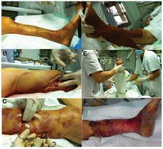 Necrotizing fasciitis is a rare bacterial disease, which infects the tissues of the skin and spreads rapidly. Septic Shock Due To Community Acquired Pseudomonas Aeruginosa Necrotizing Fasciitis A Case Report And Literature Review