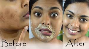 Sunscreen can help to get rid of acne scars naturally and fast. How To Remove Acne Scars Naturally