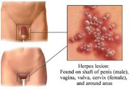 Image result for genital herpes