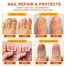 Image result for mykoza nehtů