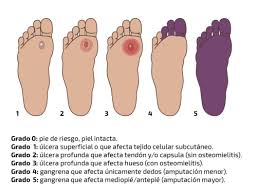 Clasificacion Del Pie Diabetico Protesis Mg Latam
