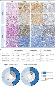 Tumorigenic role of tacrolimus through mTORC1C2 activation in  post-transplant renal cell carcinomas | British Journal of Cancer