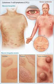 Lymph node) which demonstrate a mature t cell lymphoma that does not meet criteria for other mature t cell lymphomas in the 2016 who classification (swerdlow: Pin On Eczema