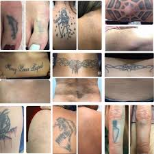 But since its free im afraid they wont do. Clean Canvas Laser Tattoo Removal Houston Texas Facebook