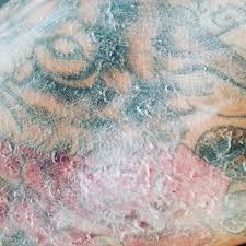 Can I Use Eczema Cream On My Tattoo Authoritytattoo