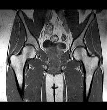 Image result for Hip XRay