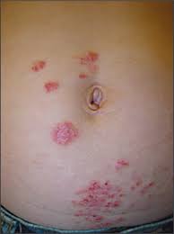 Itchy Plaques On The Abdomen Photo Quiz American Family Physician
