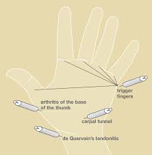 Cortisone Injections Omaha Carpal Tunnel Carpal Tunnel Doctor Carpal Tunnel Surgeon Omaha Ne