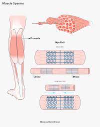 Muscle Spasms: Causes, Symptoms, And Treatment