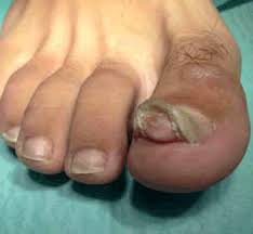 When your blocked nose could be something skin cancer is one of the most common types of cancer to be diagnosed in the uk. Racgp Subungual Nodule Of The Great Toe