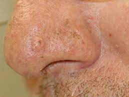 Torre Muir Syndrome Dermnet Nz